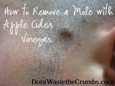 
                    
                        How to Remove a Mole with Apple Cider Vinegar - yes it really works! :: DontWastetheCrumb...
                    
                