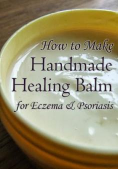 
                    
                        Skincare recipe for making a healing balm for Eczema & Psoriasis - all natural! #beauty
                    
                