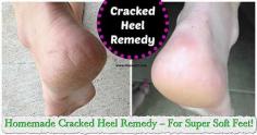 
                    
                        Homemade Cracked Heel Remedy – For Super Soft Feet!
                    
                