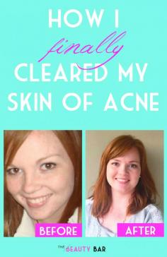 
                    
                        Beauty blogger shares her simple secret for clearing up her skin once and for all. Must-pin for anyone that suffers from acne!
                    
                