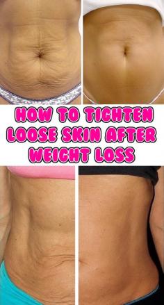
                    
                        How to Tighten Loose Skin After Weight Loss
                    
                